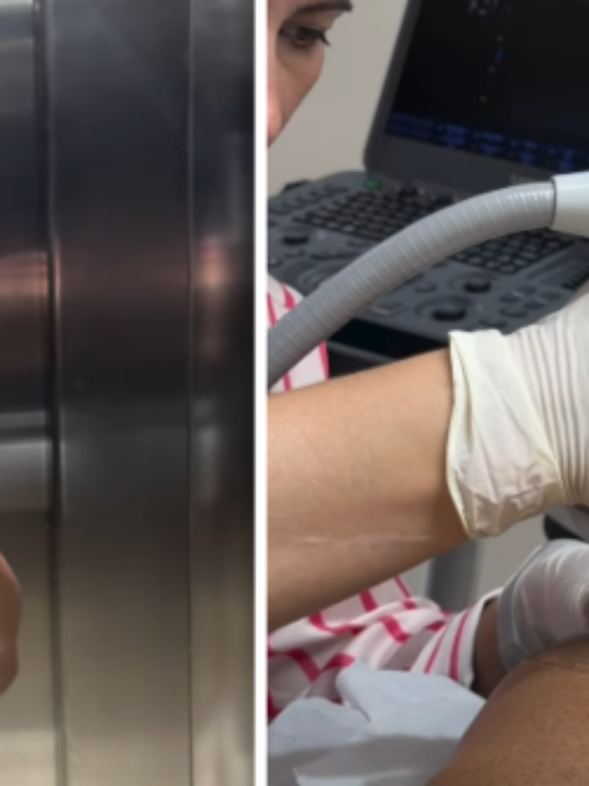 Gracyanne Barbosa recorre a punção para retirar líquido do joelho devido à 'Dança dos Famosos'