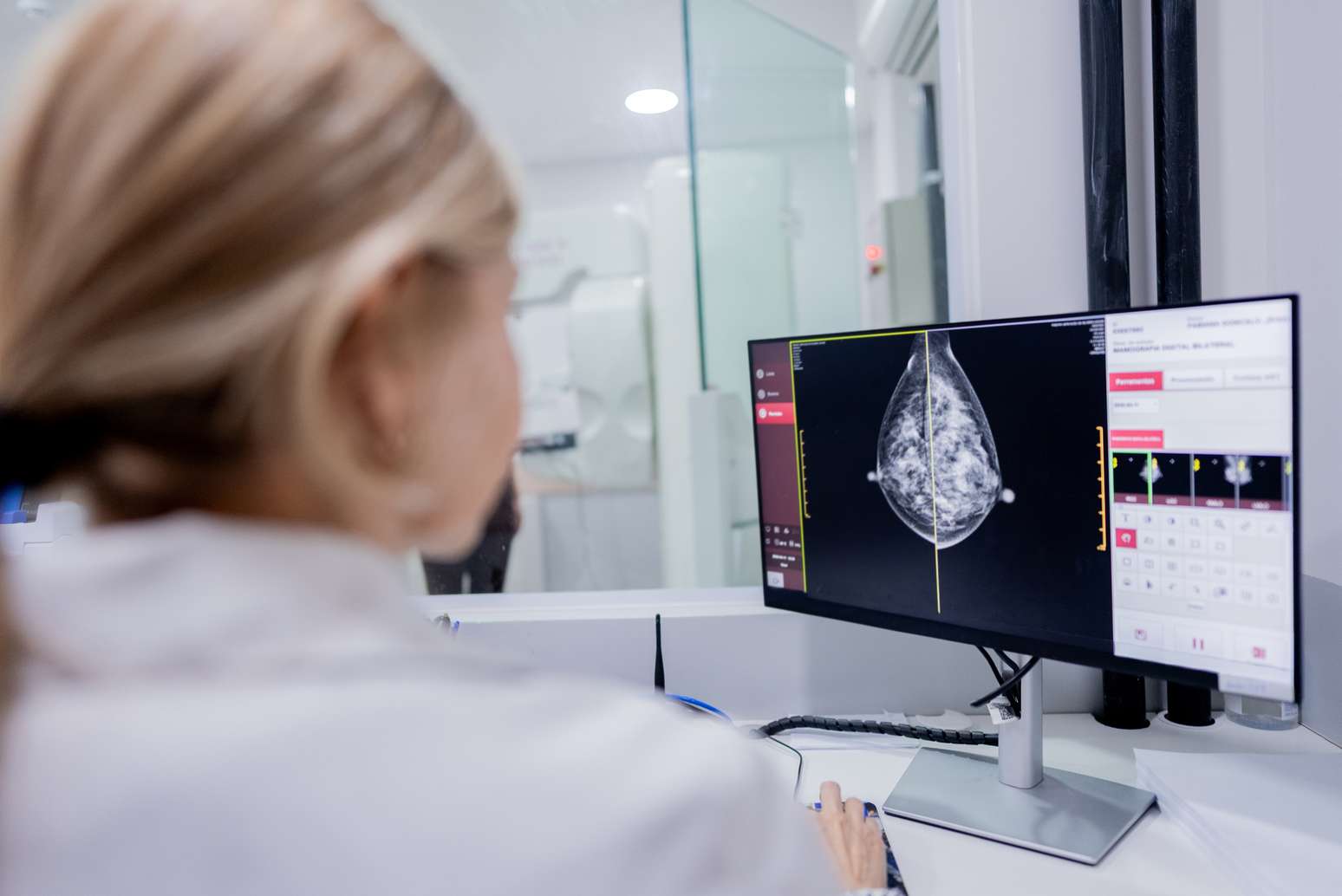 Intelig&ecirc;ncia artificial pode ajudar na detec&ccedil;&atilde;o de c&acirc;ncer de mama